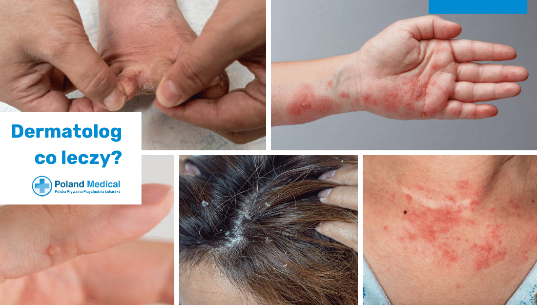 Choroby skórne, które leczy dermatolog: łupież, zapalenie skóry i inne