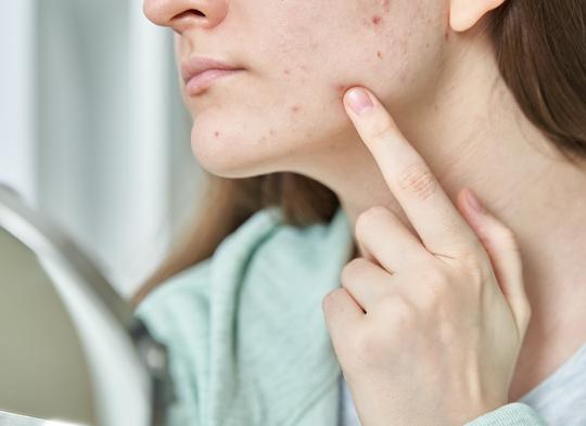 Jak pielęgnować cerę trądzikową u osób dorosłych?