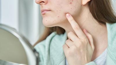 Jak pielęgnować cerę trądzikową u osób dorosłych?