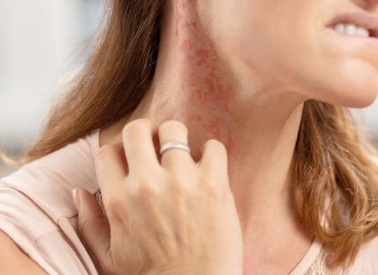 Pokrzywka stresowa - objawy i metody leczenia wysypki na tle nerwowym